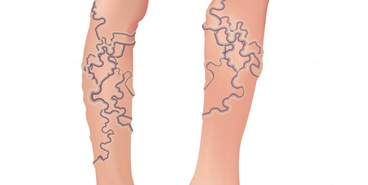 Choroba Osgood-Schlattera – przyczyny, objawy i leczenie